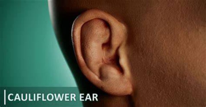 Mastering The Art Of Cauliflower Ear: A Path To Rugged Glory